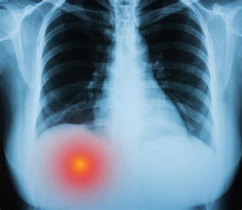 The kidneys are closer to the thoracic spine (i.e. Pain In The Back Left Side Under Ribs - ovulation symptoms