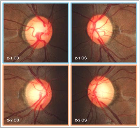 Figure 4 From Optic Nerve Head Anatomy In Myopia And Glaucoma