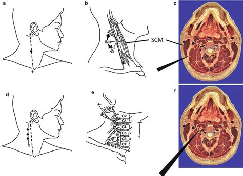 Cervical Plexus Block Radiology Key