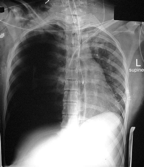 The Supine Pneumothorax Wikiradiography