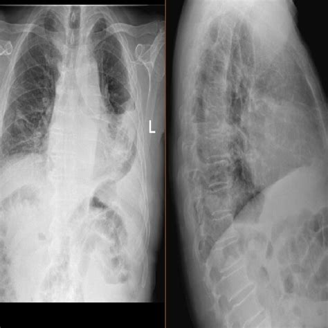 Chest Radiograph Of The Patient Showing A Left Pleural Effusion