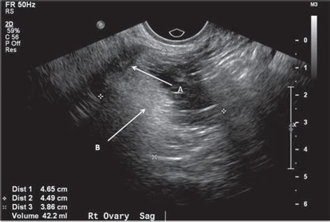 Ruptured Ovarian Cyst Ultrasound