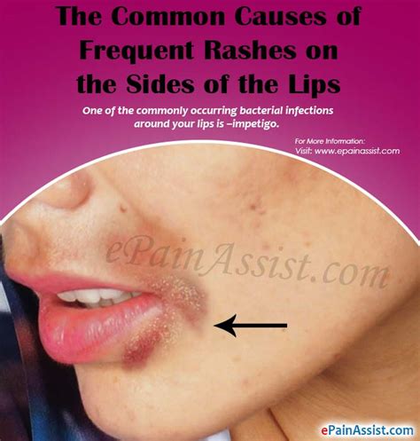 Causes Of Rashes On The Sides Of The Lips And Tips To Heal Them