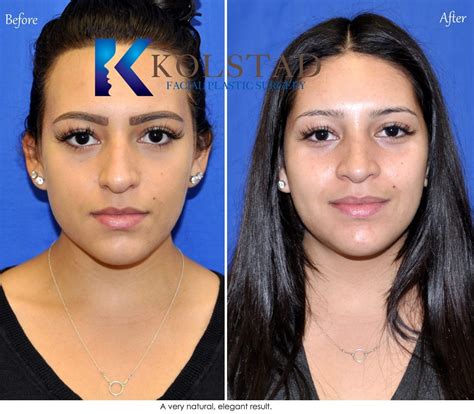 Hispanic Rhinoplasty Before And After Dr Kolstad Facial Plastics