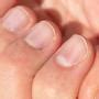 Pionowe i podłużne bruzdy na paznokciach przyczyny leczenie