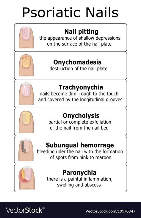Illustration Of Six Types Of Psoriatic Onychodystrophy Such As Nail