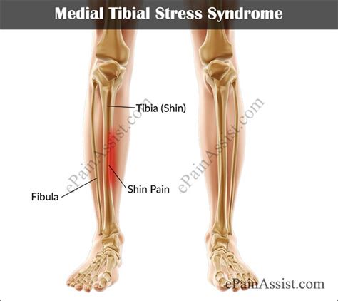 Medial Tibial Stress Syndrome Treatment Causes Symptoms