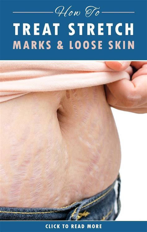 How To Treat Stretch Marks And Loose Skin Treat Stretch Marks