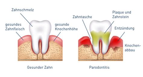 Parodontose Ursachen Symptome Behandlung