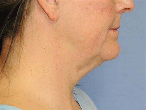 Neck Lift Before And After Photos Seattle Belleveue