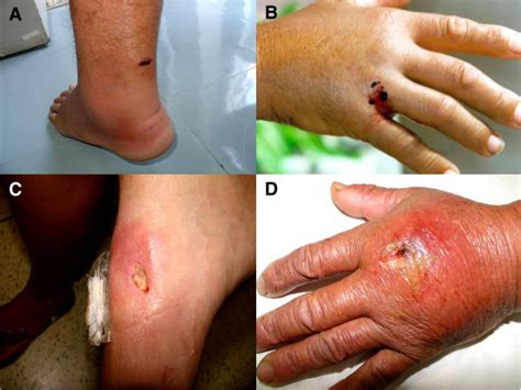 Envenomations Caused By Marine Stingrays A Erythema And Edema In A