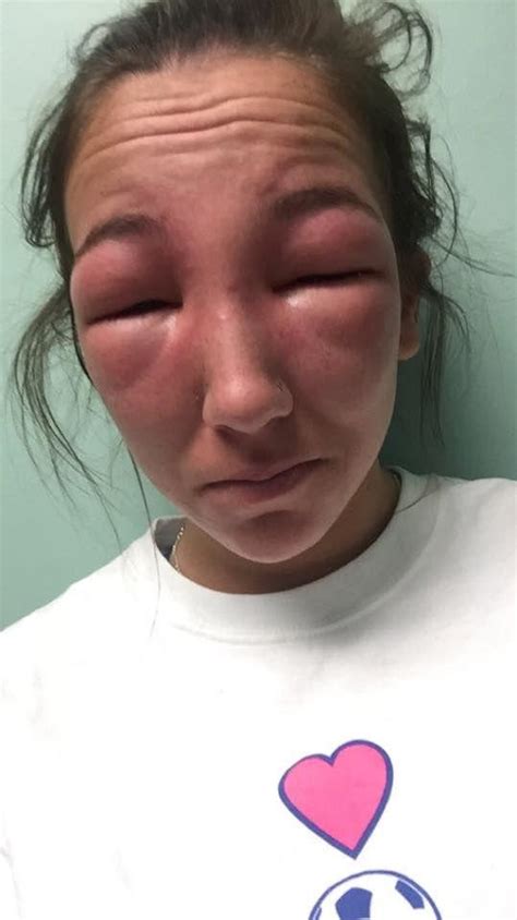 To find out if you are allergic to cats, you need to pay attention to certain signs and symptoms. Girl Has Awful Allergic Reaction To Poison Ivy (2 pics)