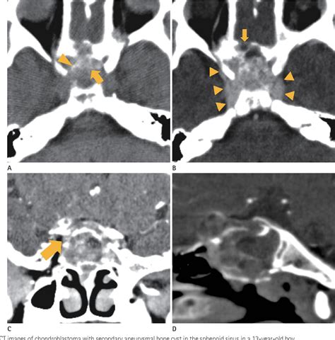 Figure 1 From Chondroblastoma With Secondary Aneurysmal Bone Cyst In