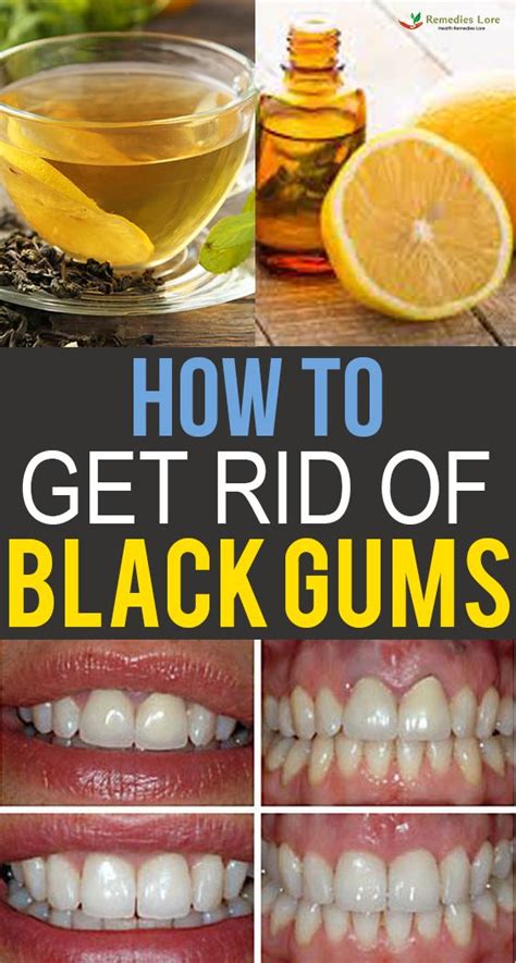 How To Get Rid Of Black Gums Black Gums Gum Care Healthy Teeth