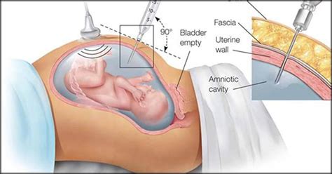 How To Recognize Leaking Amniotic Fluid And What To Do