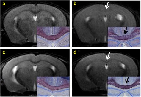 T W Mri Compared To Bgii T W Rare Coronal Images And Pathologic Download Scientific Diagram