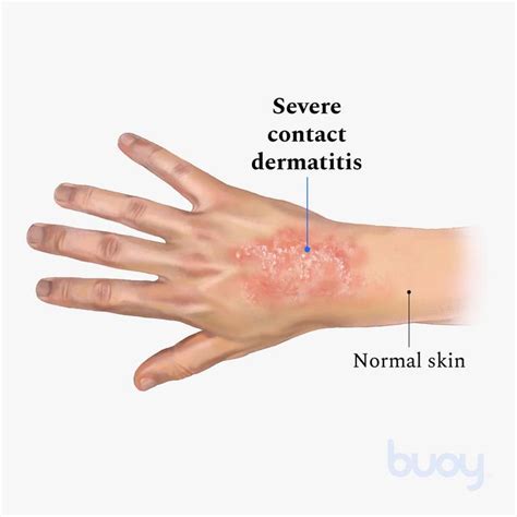 What Is Contact Dermatitis And How To Treat Them