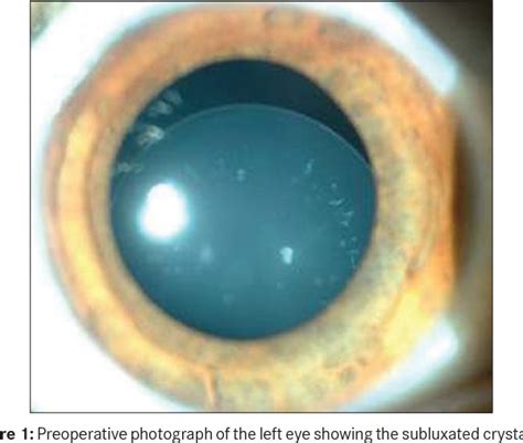 Figure 1 From Bilateral Transient Pupil Closure After Iris Supported