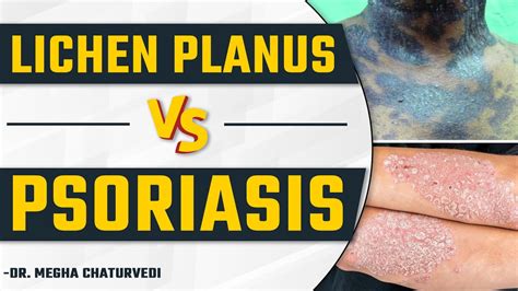 Lichen Planus Treatment Lichen Planus Vs Psoriasis Dr Health Dr