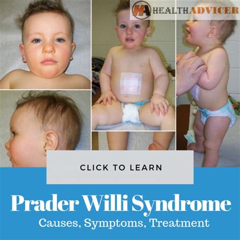 Prader Willi Syndrome Causes Picture Symptoms Treatment