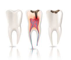 You may have the capacity to. All About Root Canal Cost Without Insurance - Your Guide to Insurance