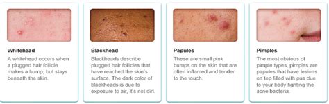According to the american academy of dermatology, approximately 50 million americans struggle with acne each year. Redefining the Face Of Beauty : TEEN SKIN CARE. WHY YOUR ...