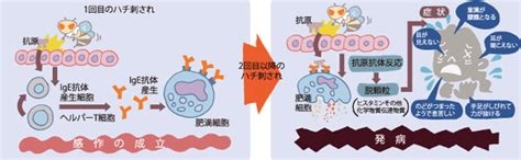 Ария — алия アラ ара — алла アルスー арусу: アナフィラキシー | かわの内科 アレルギー科（徳島県 鳴門市）