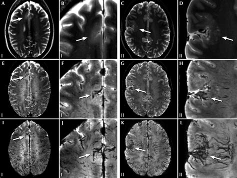 A A Mri Findings Of Patients With Confirmed Fcd And T 2 Signal