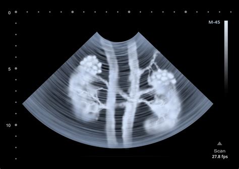 Research In Polycystic Kidney Disease Takes An Important Step Forward