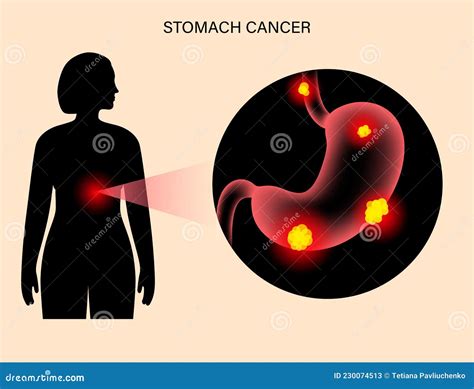 Anatomia Del Cancro Allo Stomaco Illustrazione Vettoriale Illustrazione Di Cancro Addominale