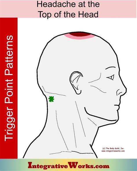 Pin On Headache Trigger Point Pain