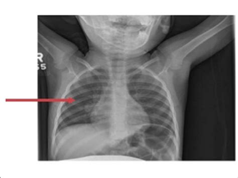 Chest X Ray Of A 2 Year Old Female Child The Chest X Ray Cxr Shows A