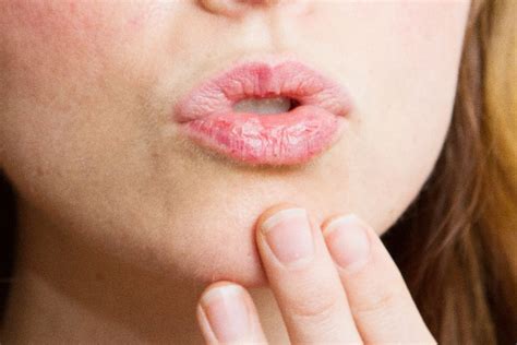 Best Home Remedies For Cracked Lips Corner Or Angular Cheilitis Hergamut
