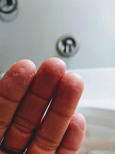 My Fingertips Peeling After A Climbing Hiatus Of 4 Weeks R