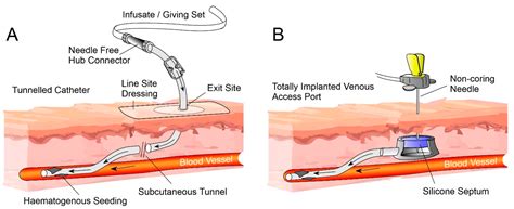 Indwelling Venous Catheter