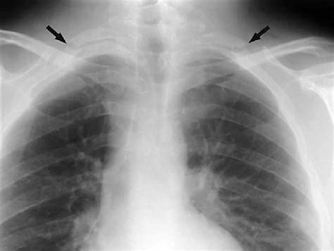 Chest Radiograph Showing Bilateral First Rib Fractures Arrowed
