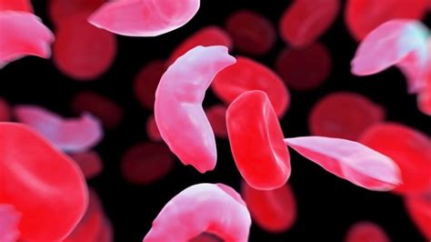 Lightning Learning Sickle Cell Crisis — Em3