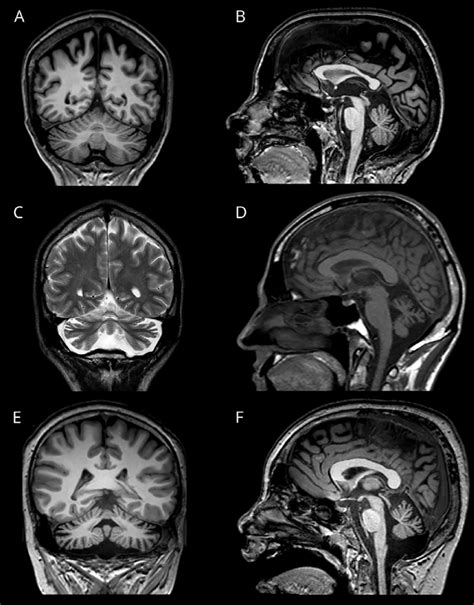 Patients Mri Showing Cerebellar Atrophy Download Scientific Diagram