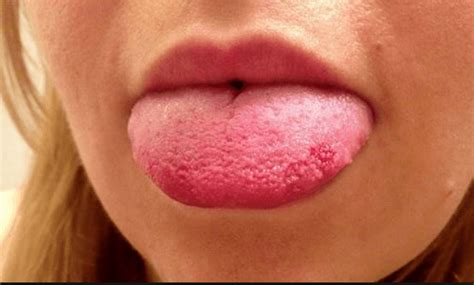 Bumps On Back Of Tongue Causes Symptoms And Treatments