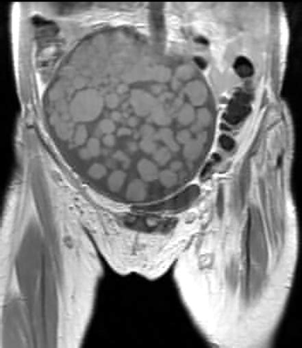 Balls Of Fat Dermoid Cyst Sumers Radiology Blog