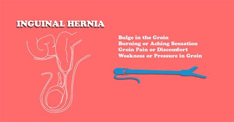 Inguinal Hernia Hernia Symptoms Sensation Symptoms