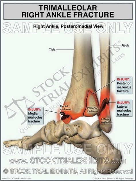 This Trial Exhibit Depicts A Trimalleolar Right Ankle Fracture Showing