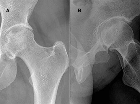 Collapsed Femoral Head