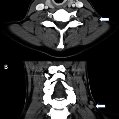 A Soft Tissue CT Scan Of The Neck Indicated Lymphadenopathy A Axial