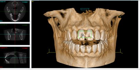 Big Trends In Dental Technology 3d Imaging And “cone Beam” Computed