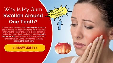 Swollen Bleeding Gums Around One Tooth Speaker Deck