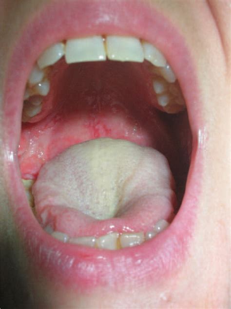 Management Of Oral Pemphigus Vulgaris A Case Report And A Clinical