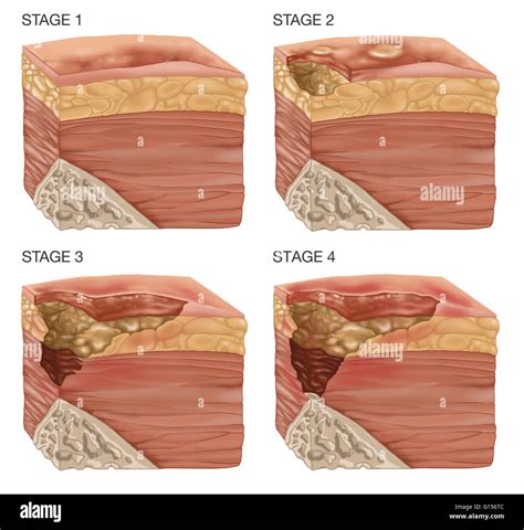 Illustration Of The Stages Of A Bedsore Bedsores Or Pressure Sores