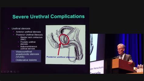 Management Of Post Prostatectomy Incontinence Sender Herschorn ICS Tokyo YouTube