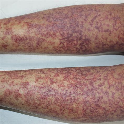 Multiple Erythematous To Violaceous Reticular Maculopapular Lesions